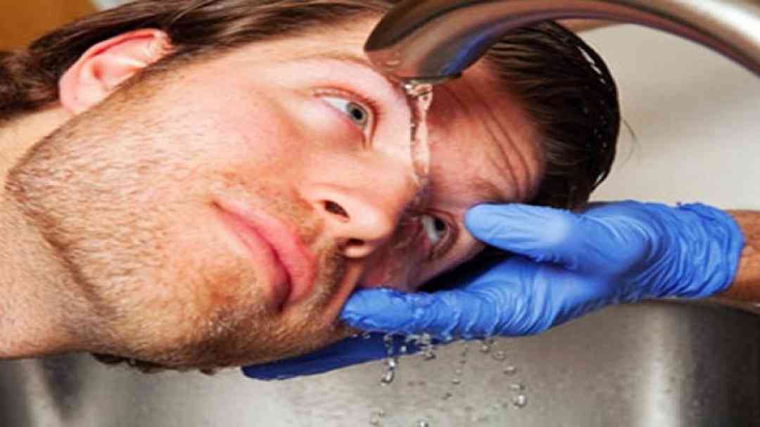 Cách điều trị khi bị bắn hóa chất vào mắt